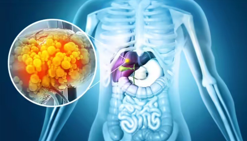Fatty Liver Home Remedy