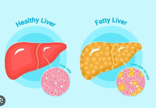 Fatty Liver Home Remedy